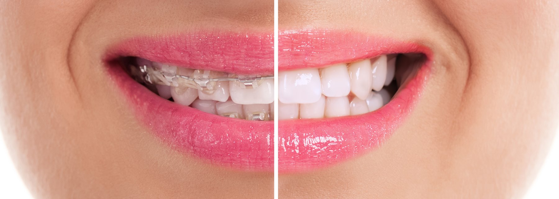 Before & After Orthodontic Transformations in Little Rock, Arkansas